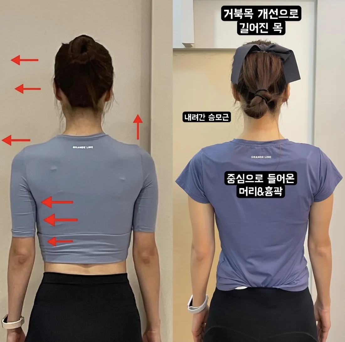 포즈필라테스 비포애프터 — 거북목 개선 · 승모근 하강