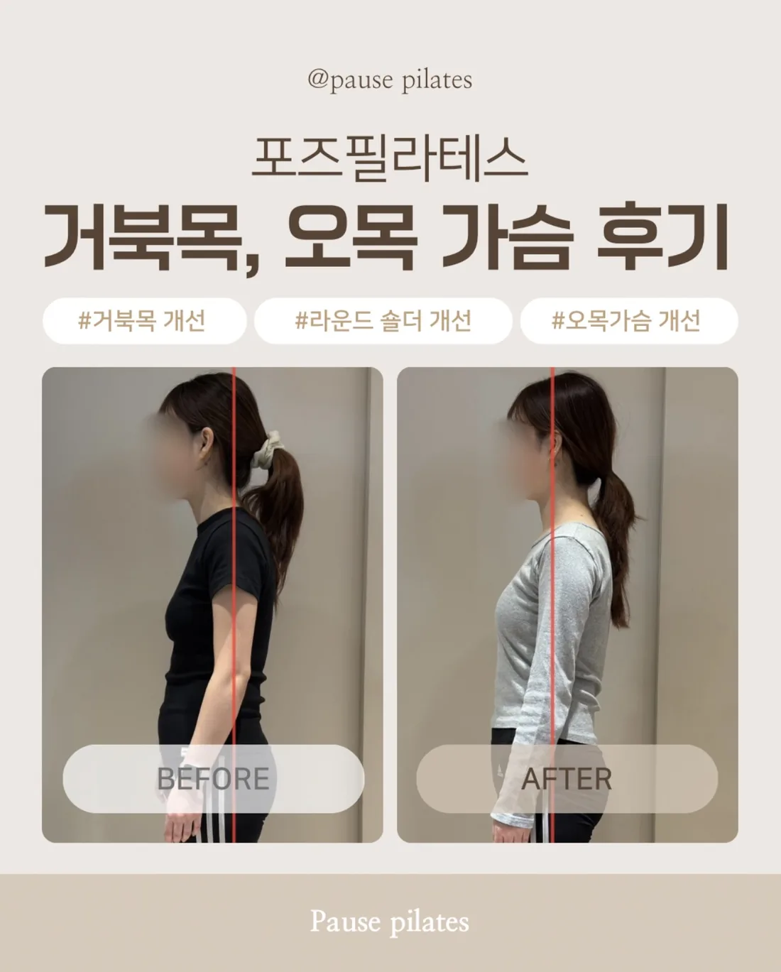 포즈필라테스 비포애프터 — 거북목 · 오목가슴