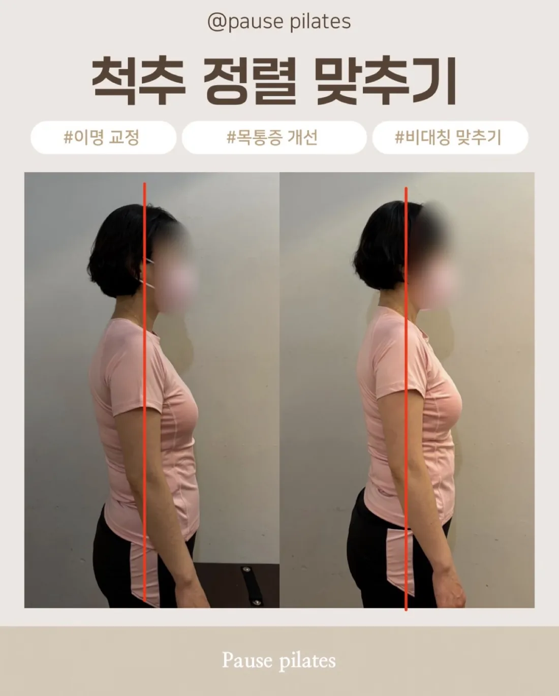 포즈필라테스 비포애프터 — 척추 정렬 · 목통증