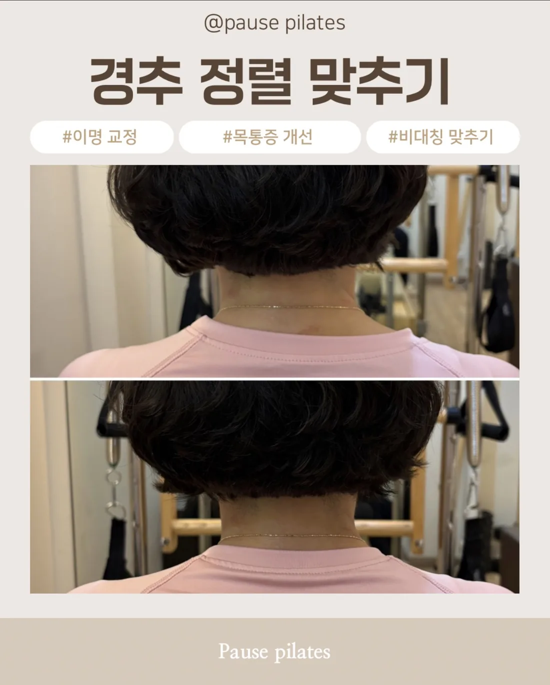 포즈필라테스 비포애프터 — 경추 정렬 · 뒷목 라인